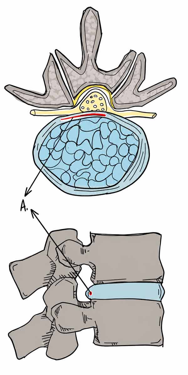 Resonancia magnética referencial de una hernia discal